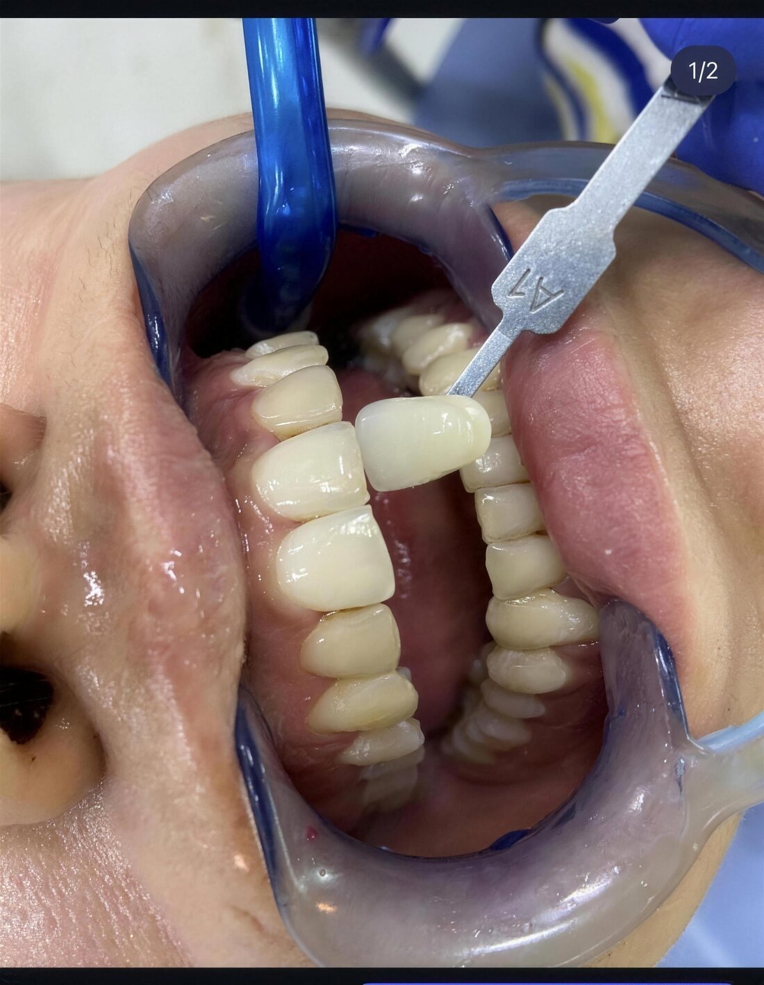 Carillas de porcelana dental sobre fondo blanco